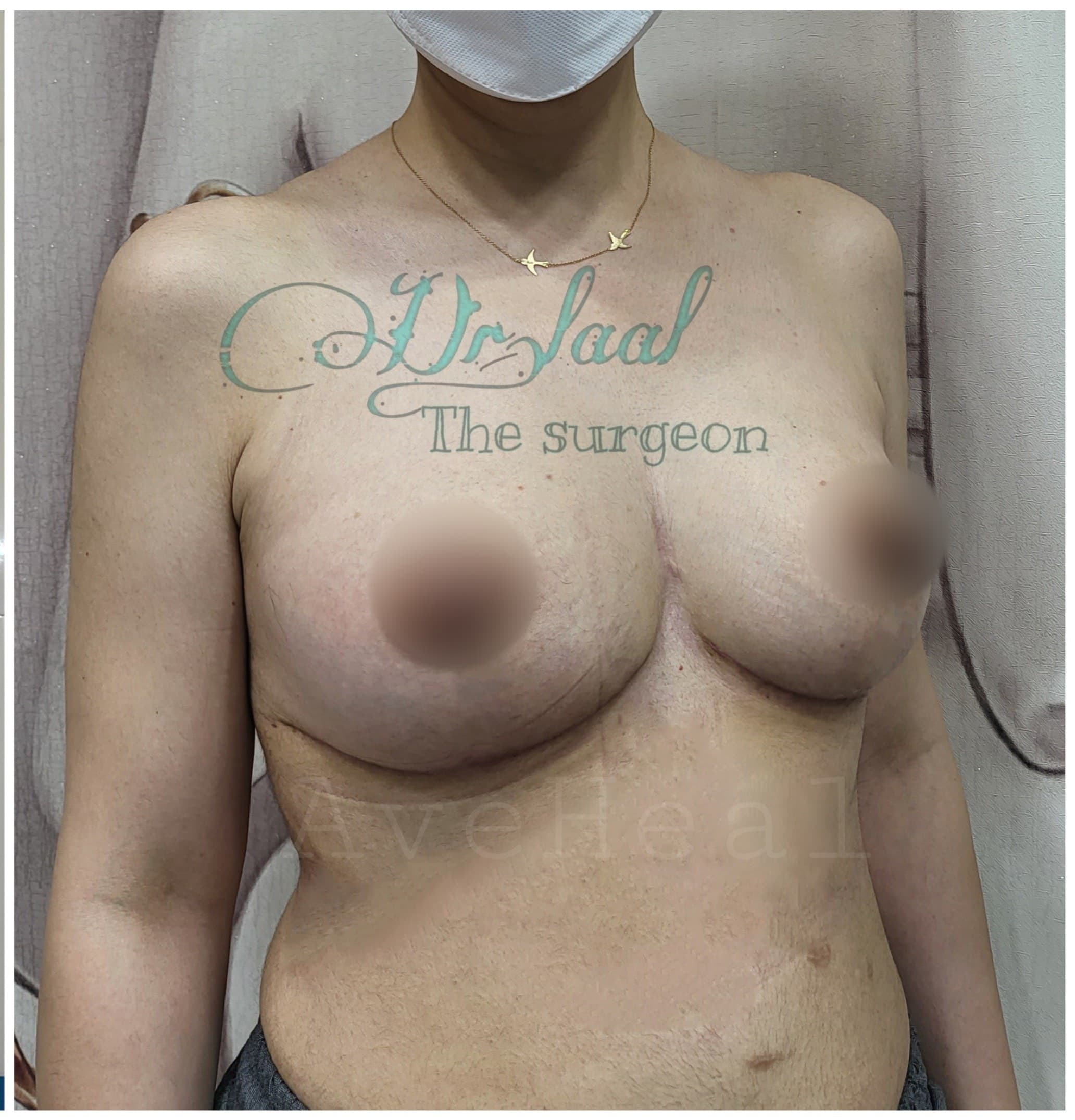 after-breast-lift-dr-homeira-laal-khoshab